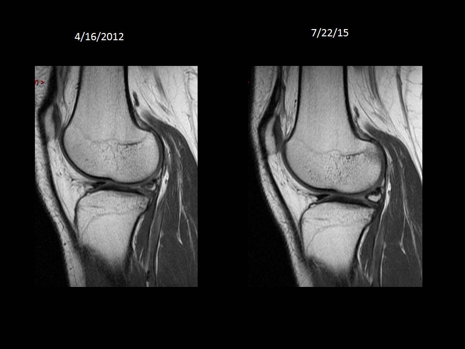Figure 2 for case Meniscle ossicle ( RID10149 )